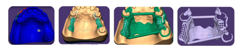 Fluxo digital CAD/CAM para fabricação de prótese parcial removível, mostrando etapas de design 3D e estrutura final em modelagem virtual.